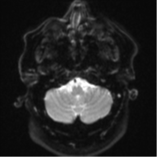 Cerebral metastases mimicking multifocal glioblastoma (Radiopaedia 50843-56353 Axial DWI 5).png