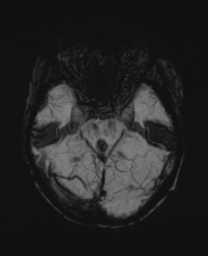 File:Cerebral metastasis (Radiopaedia 46744-51248 Axial SWI 11).png