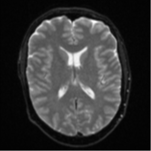Cerebral metastasis - colorectal adenocarcinoma (Radiopaedia 50394-55765 Axial DWI 15).png