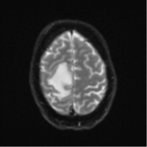 Cerebral metastasis - colorectal adenocarcinoma (Radiopaedia 50394-55765 Axial DWI 23).png
