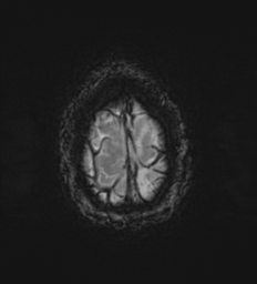 Cerebral metastasis - melanoma (Radiopaedia 54718-60954 Axial SWI 53).png
