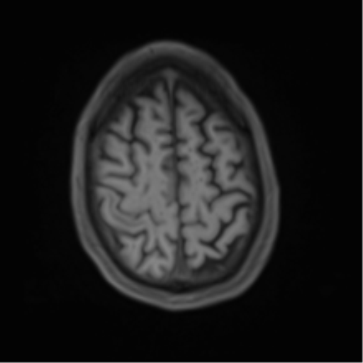 File:Cerebral metastasis - melanoma (Radiopaedia 54718-60954 Axial T1 44).png