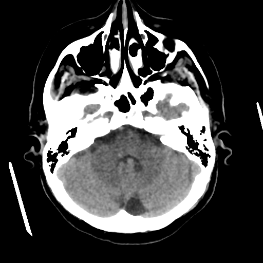 Cerebral metastasis to basal ganglia (Radiopaedia 81568-95412 Axial non-contrast 19).png