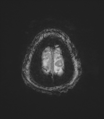 Cerebral metastasis to basal ganglia (Radiopaedia 81568-95413 Axial SWI magnitude 85).png