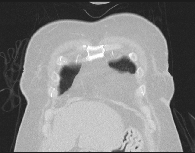 File:Cerebral metastasis to basal ganglia (Radiopaedia 81568-95414 Coronal lung window 16).png