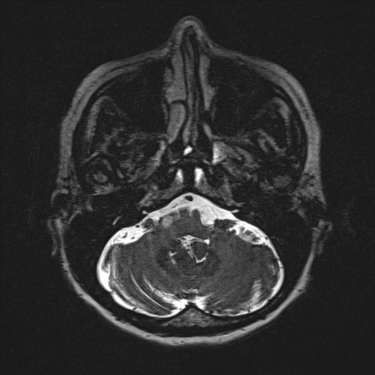 Cerebral ring enhancing lesions - cerebral metastases (Radiopaedia 44922-48817 F 21).jpg