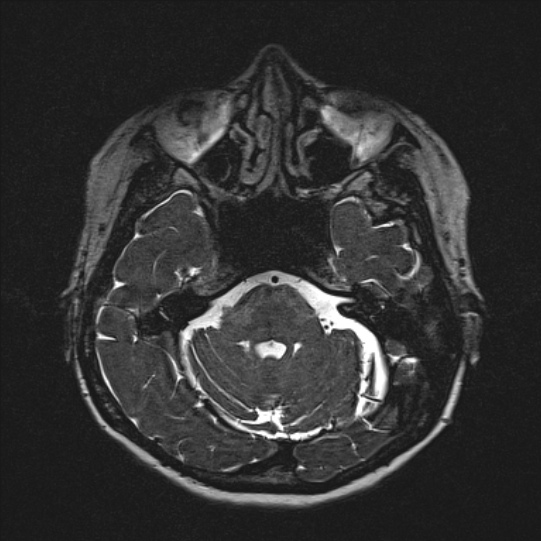 Cerebral ring enhancing lesions - cerebral metastases (Radiopaedia 44922-48817 F 43).jpg