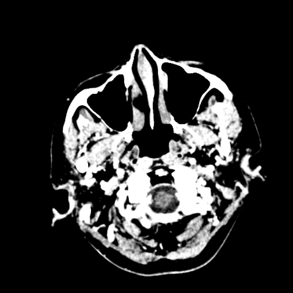 Cerebral ring enhancing lesions - cerebral metastases (Radiopaedia 44922-48818 B 20).jpg