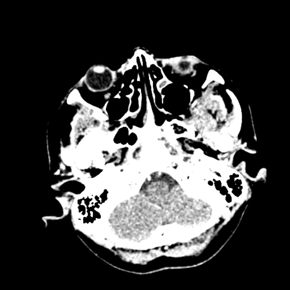 Cerebral ring enhancing lesions - cerebral metastases (Radiopaedia 44922-48818 B 45).jpg