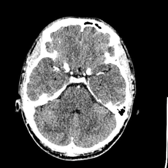 Cerebral toxoplasmosis (Radiopaedia 53993-60131 Axial C+ delayed 23).jpg