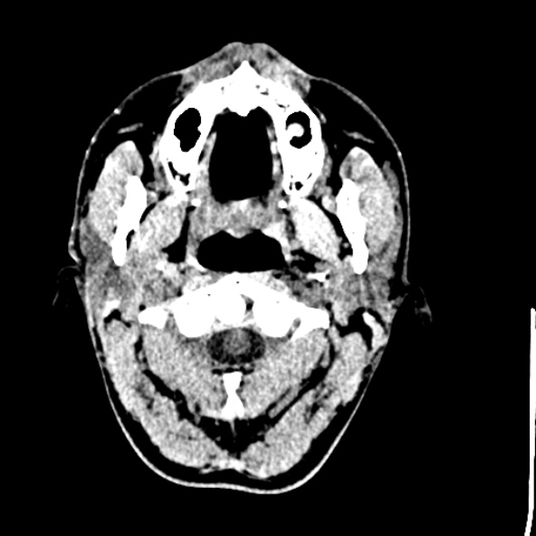 Cerebral toxoplasmosis (Radiopaedia 53993-60131 Axial non-contrast 1).jpg