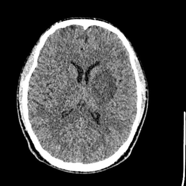 Cerebral toxoplasmosis (Radiopaedia 53993-60131 Axial non-contrast 45).jpg