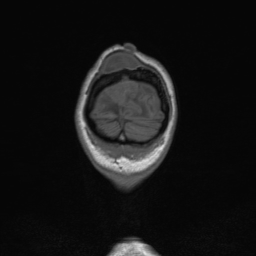 Cerebral tuberculosis with dural sinus invasion (Radiopaedia 60353-68090 Coronal T1 170).jpg