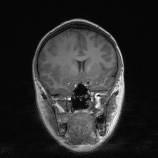 Cerebral tuberculosis with dural sinus invasion (Radiopaedia 60353-68090 Coronal T1 77).jpg