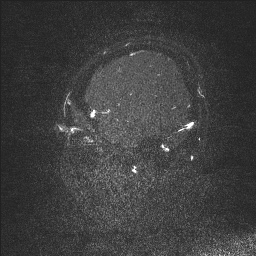 Cerebral tuberculosis with dural sinus invasion (Radiopaedia 60353-68090 Sagittal MRV 12).jpg