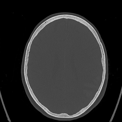Cerebral venous infarction with hemorrhage (Radiopaedia 65343-74381 Axial bone window 117).jpg