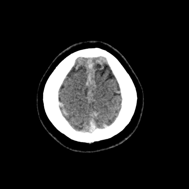 Cerebral venous sinus thrombosis (Radiopaedia 59224-66551 Axial non-contrast 52).jpg