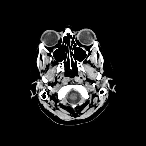 Cerebral venous throbmosis - hemorrhagic venous infarction (Radiopaedia 87318-103613 Axial non-contrast 11).jpg