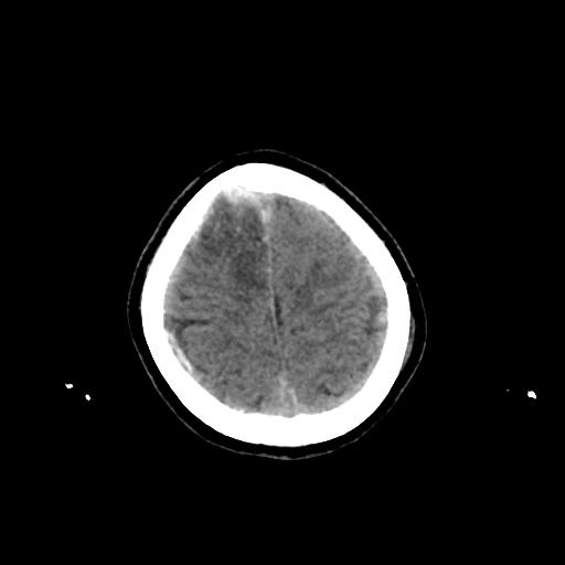 Cerebral venous throbmosis - hemorrhagic venous infarction (Radiopaedia 87318-103613 Axial non-contrast 151).jpg