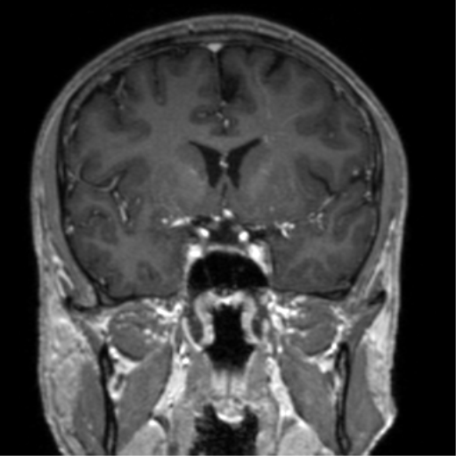 Cerebral venous thrombosis (Radiopaedia 38392-40469 Coronal T1 C+ 54).png
