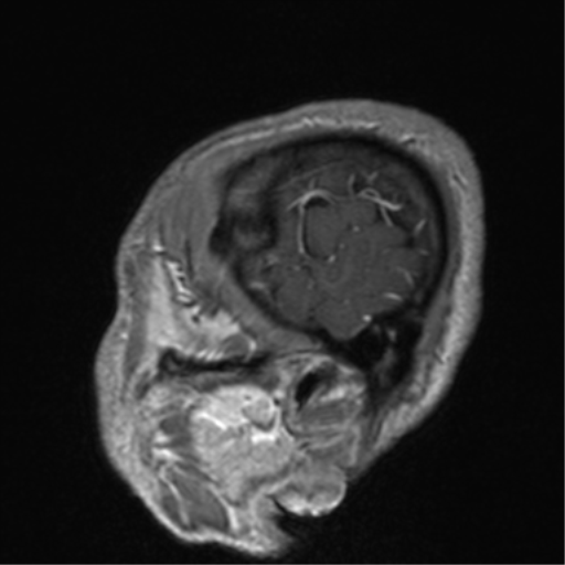 Cerebral venous thrombosis (Radiopaedia 38392-40469 Sagittal T1 C+ 13).png