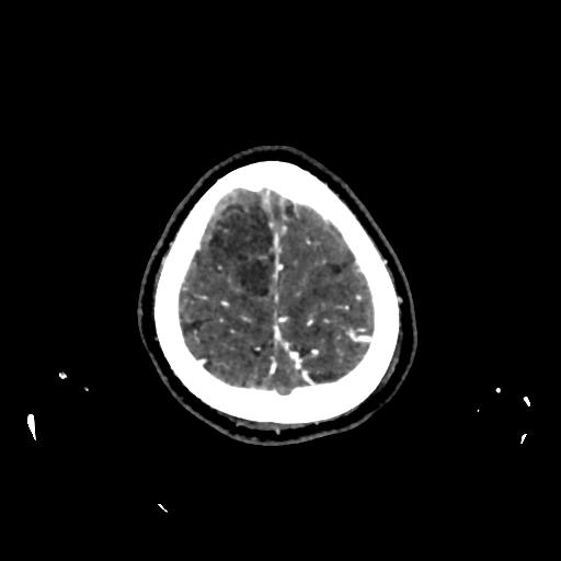 File:Cerebral venous thrombosis - hemorrhagic venous infarction (Radiopaedia 87318-103613 Axial 246).jpg