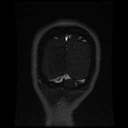Cerebral venous thrombosis - ulcerative colitis (Radiopaedia 66049-75219 Coronal MRV 15).jpg
