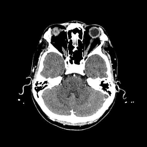 Cerebral venous thrombosis with venous hemorrhagic infarct (Radiopaedia 90354-107660 Axial with contrast 49).jpg
