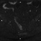 Cervical adenocarcinoma (Radiopaedia 65011-73985 Axial DWI 69).jpg