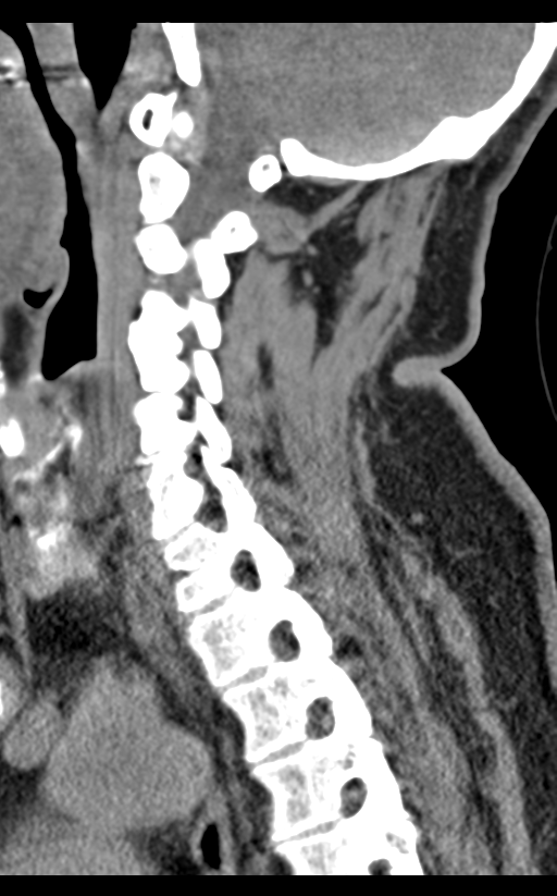 Cervical canal stenosis - OPLL and osteophytes (Radiopaedia 47329-51910 B 33).png