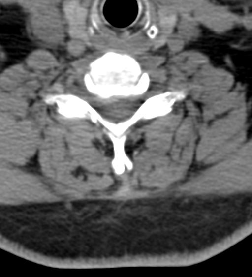 Cervical canal stenosis due to ossification of the posterior longitudinal ligament (Radiopaedia 47260-51823 Axial non-contrast 44).png