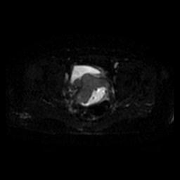 File:Cervical carcinoma (Radiopaedia 67644-77047 Axial DWI 37).jpg
