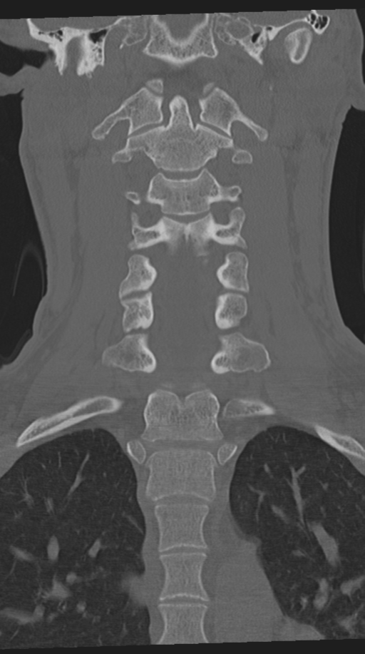 Cervical intercalary bone (Radiopaedia 35211-36748 Coronal bone window 38).png