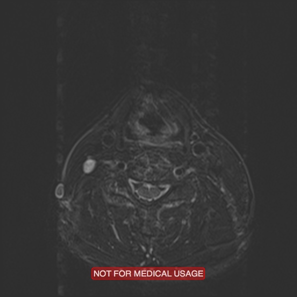 Cervical nerve schwannoma (Radiopaedia 27964-28221 C 35).jpg