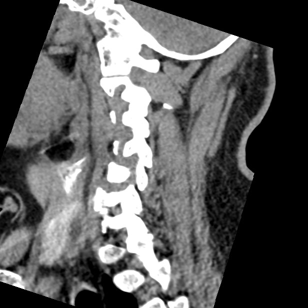 Cervical spinal neurofibroma in a patient with NF1 (Radiopaedia 58344-65464 C 36).jpg