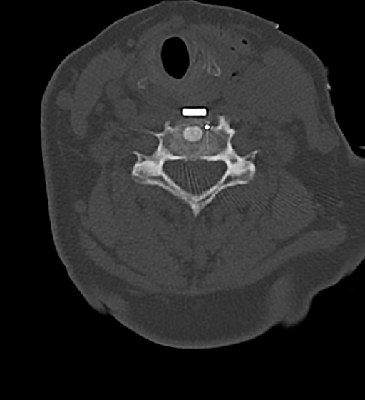 Cervical spine ACDF loosening (Radiopaedia 48998-54070 Axial bone window 38).png