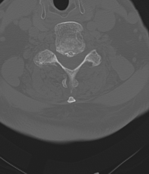 File:Cervical spine fracture in the setting of ankylosis (Radiopaedia 37038-38715 Axial bone window 38).png