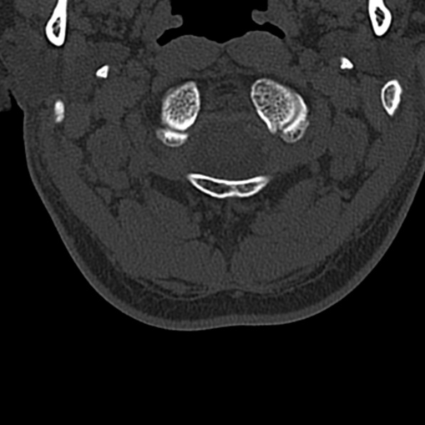 Cervical spondylodiscitis (Radiopaedia 28057-29489 Axial bone window 15).jpg