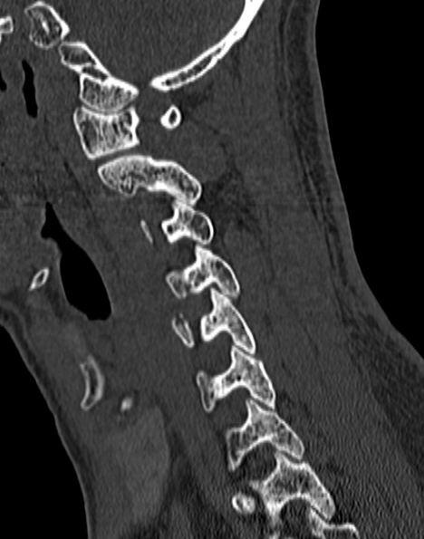 Cervical spondylodiscitis (Radiopaedia 28057-29489 Sagittal bone window 42).jpg
