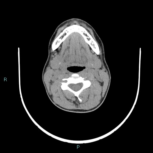 File:Cervical thymic cyst (Radiopaedia 88632-105335 Axial non-contrast 72).jpg