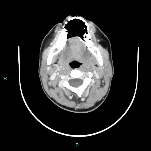 Cervical thymic cyst (Radiopaedia 88632-105335 C 84).jpg