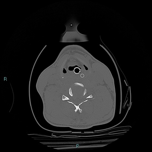 File:Cervical vertebral burst fracture (Radiopaedia 37420-39258 Axial bone window 17).jpg
