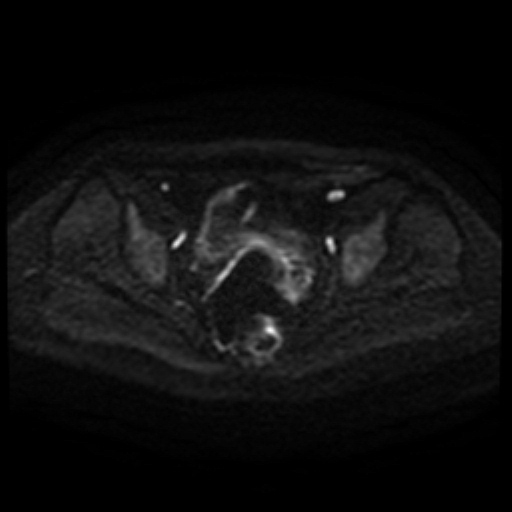 Cesarian section scar endometriosis (Radiopaedia 66520-75799 Axial DWI 89).jpg