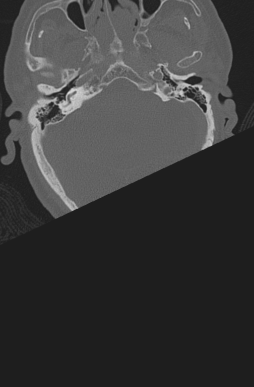 Chalk stick fracture (Radiopaedia 57948-64928 Axial bone window 4).png