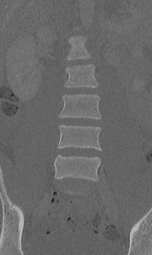 Chance fracture (Radiopaedia 40360-42912 Coronal bone window 22).png
