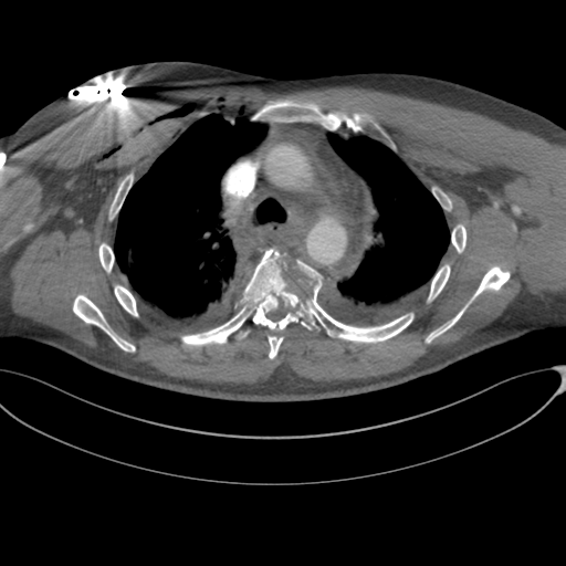 File:Chest multitrauma - aortic injury (Radiopaedia 34708-36147 A 101).png