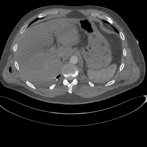 File:Chest multitrauma - aortic injury (Radiopaedia 34708-36147 A 272).png
