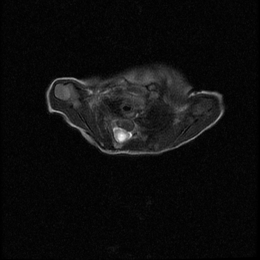 File:Chiari II malformation with spinal meningomyelocele (Radiopaedia 23550-23652 Axial T2 2).jpg