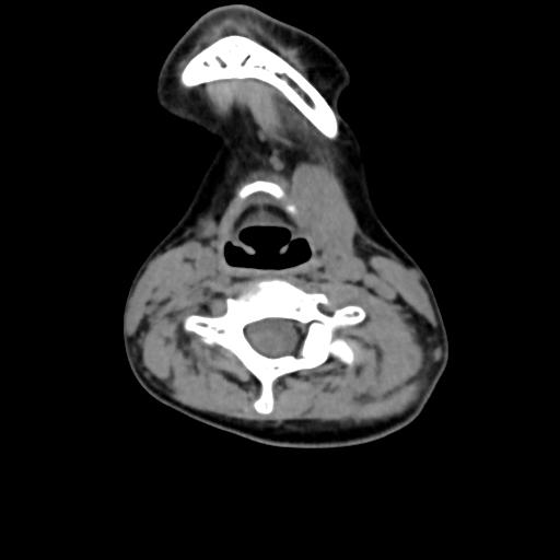 Chiari I with syrinx and skull base anomalies (Radiopaedia 89444-106412 Axial non-contrast 93).jpg