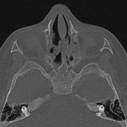 Choanal atresia (Radiopaedia 88525-105975 Axial bone window 53).jpg